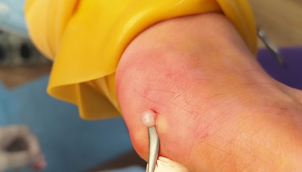 Imagen de una cirugía podológica para tratar problemas en los pies.