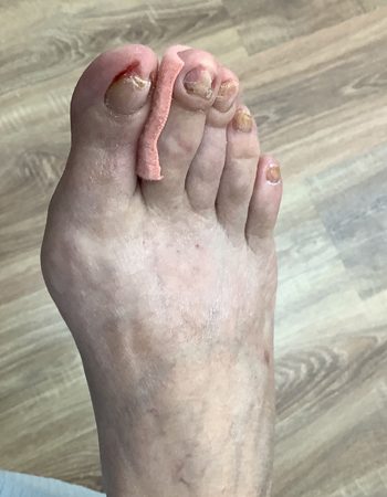 Imagen que muestra las uñas de los pies antes del tratamiento en Ines Podologa Geriatrica