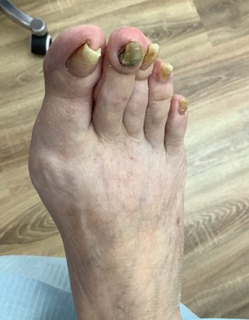 Imagen que muestra las uñas de los pies antes del tratamiento en Ines Podologa Geriatrica